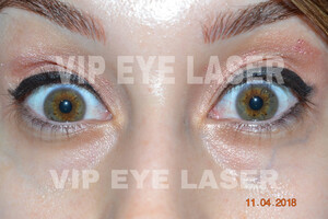 VIP Eye Laser _1