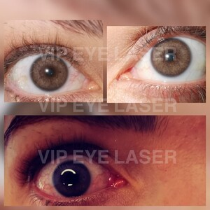VIP Eye Laser _2