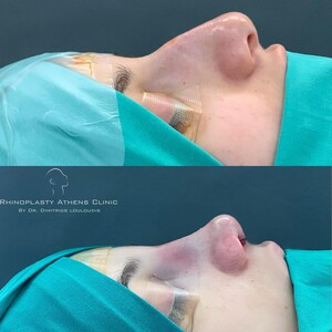 Rhinoplasty Athens Clinic by Dimitris Louloudis _2