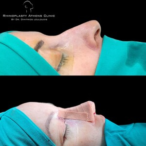 Rhinoplasty Athens Clinic by Dimitris Louloudis _0