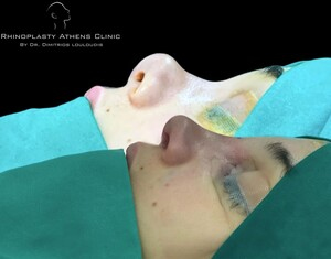 Rhinoplasty Athens Clinic by Dimitris Louloudis _1