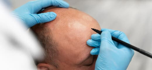 The Complete Guide to FUE Hair Transplant