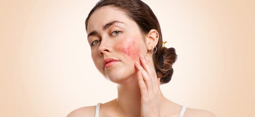 Exploring Effective Rosacea Treatments and Skin Care