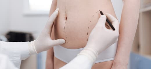 The Complete Guide to Liposuction