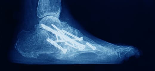Ankle Fusion (Arthrodesis) Surgery Procedure & Recovery