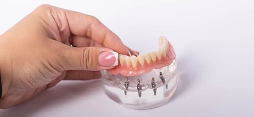 The Revolutionary All on 4 Dental Implants Procedure