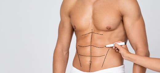 Abdominal Etching: Procedure, Cost, Recovery, and More