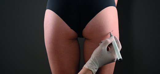 What to Know About Butt Implants?