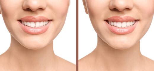 Can Dental Bonding Be Redone?