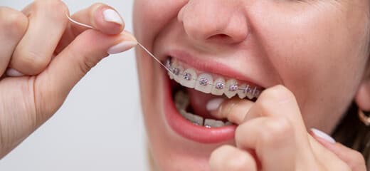 Dental Braces and Retainers: Types, Care, What to Expect