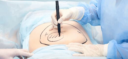 6 Things You Should Do For Your Tummy Tuck Scars