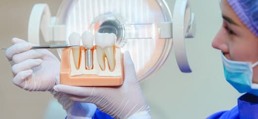 Dental Implant Procedure for Natural Looking Tooth Replacement