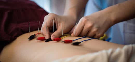 Electro-Acupuncture: Effective and Safe Pain Relief