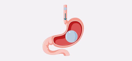 The Complete Guide to Gastric Balloon
