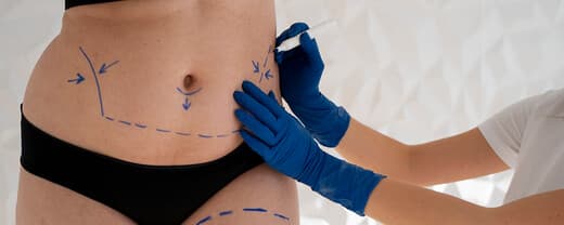 FAQs About Liposuction