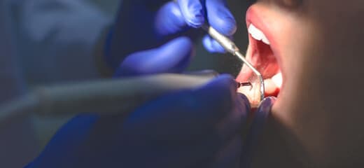 What Is the Cost of a Deep Teeth Cleaning?