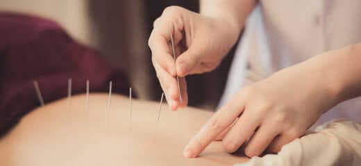 Discover the Power of Acupuncture: Benefits, Risks, and Future Prospects