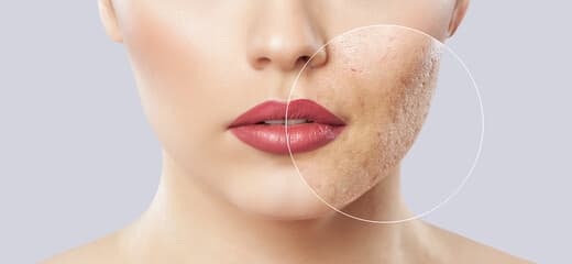 Acne Scars Treatment and Effectiveness