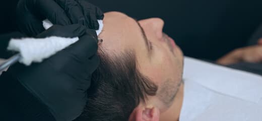 Scalp Micropigmentation: Benefits, Side Effects, & Results