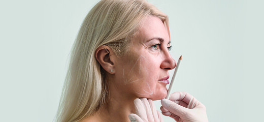 Facelift Without Surgery? Here are the Treatment Experts