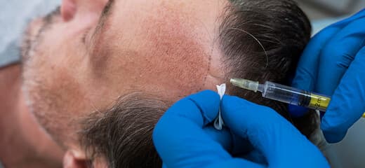 Biofibre Hair Implant