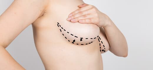 A Comprehensive Guide to Breast Lift Surgery