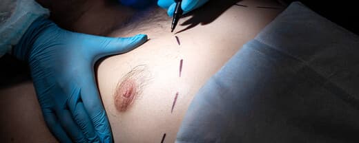 Curious about Gynecomastia Surgery?