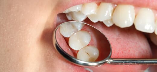 Dental Fillings Procedure to Repair Cavities and Prevent Decay