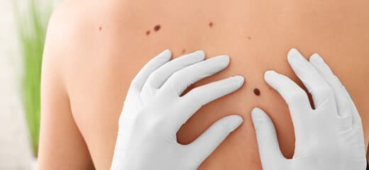Effective Mole Assessment for Skin Safety