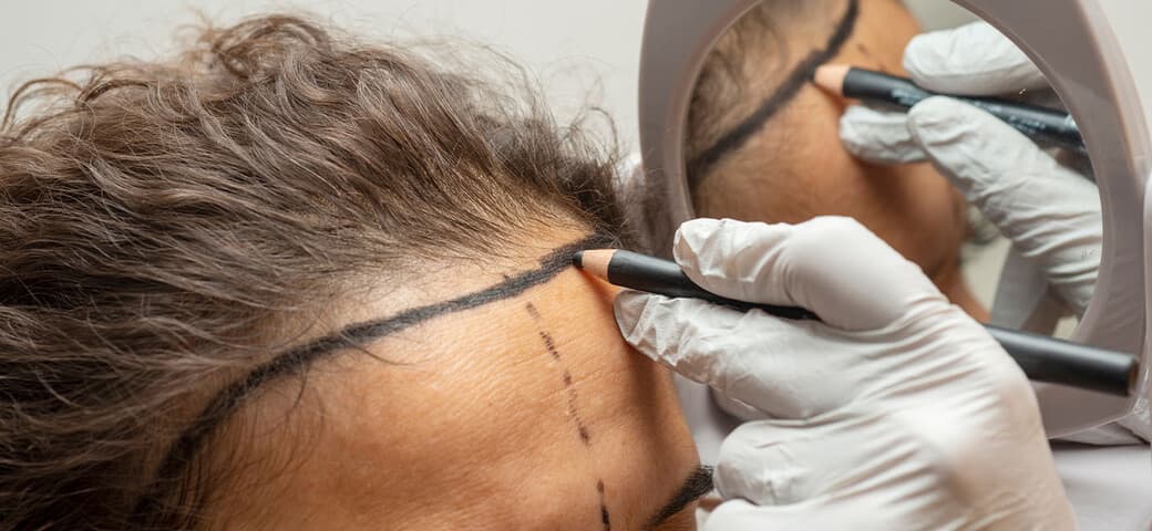Frequently Asked Questions About Hair Transplants