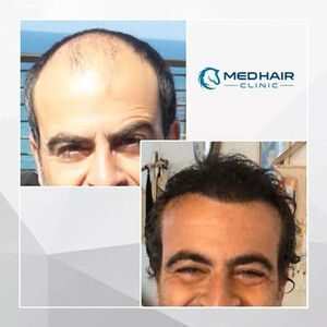 Medhair Clinic Hair Transplant _3