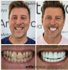 Smile Antalya Dental _2