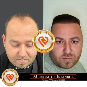 Medical of Istanbul HairTransplant _2
