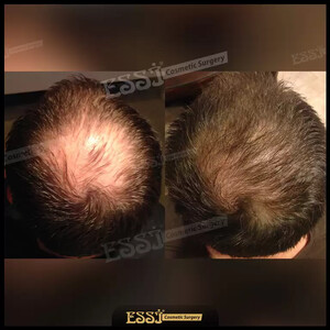 Essi Hair Transplant Clinic _3