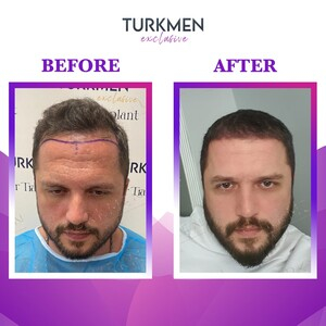 Turkmen Hair Transplant _1