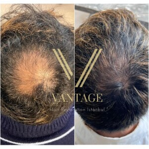 Vantage Hair Restoration _2