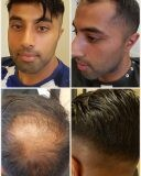 Hair Loss Clinics _3