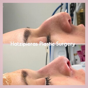 Hatzipieras Plastic Surgery _1