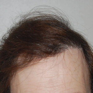 Wimpole Hair Transplant Clinic _2