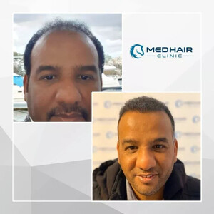 Medhair Clinic Hair Transplant _2