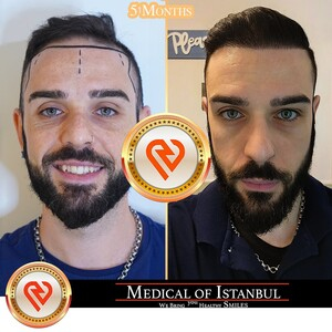Medical of Istanbul HairTransplant _0