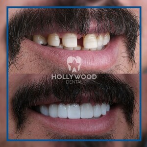 Hollywood Dental Izmir _3