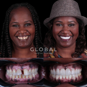 Global Dental Center Turkey _3