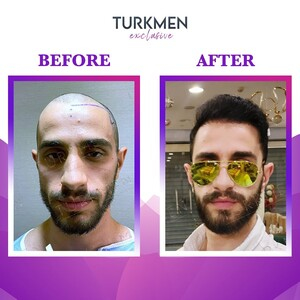 Turkmen Hair Transplant _3