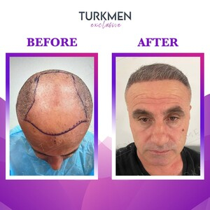 Turkmen Hair Transplant _2