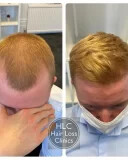 Hair Loss Clinics _2