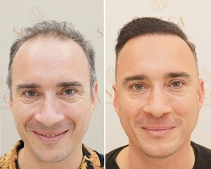Seneca Hair Transplant _3