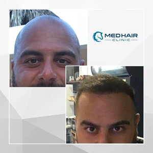 Medhair Clinic Hair Transplant _1