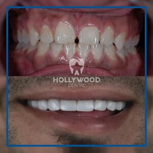 Hollywood Dental Izmir _1