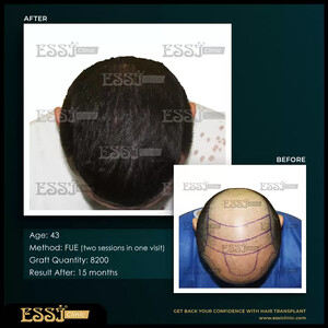 Essi Hair Transplant Clinic _0